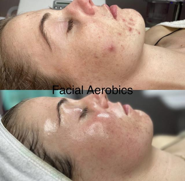 Facial Aerobics - 1
