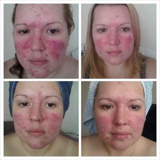 Re: Acne :(