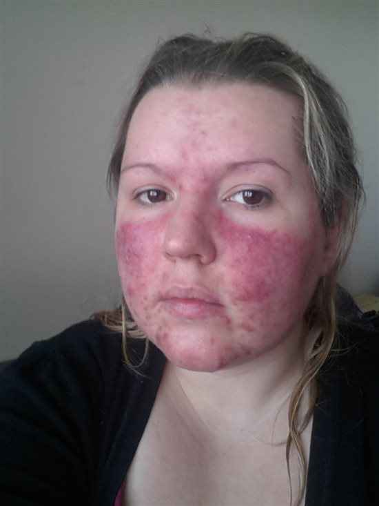 Re: Acne :(
