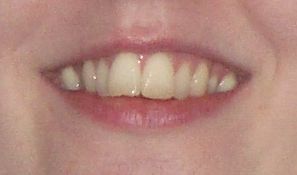 Re: People who've had their teeth straightened/ any dentists