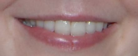 Re: professional teeth whitening