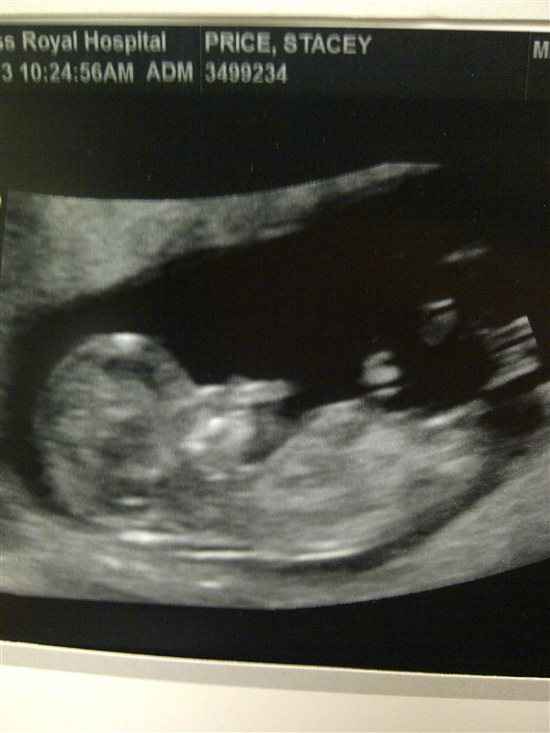 *BT* Scan