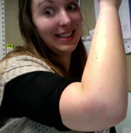 My arm burn has healed up...BUT......