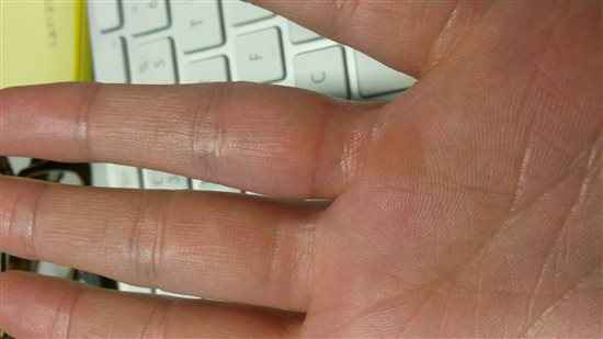 Wedding rings too tight?