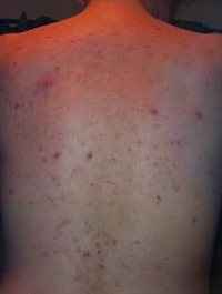 Re: Acne :(