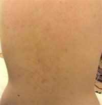 Re: Acne :(