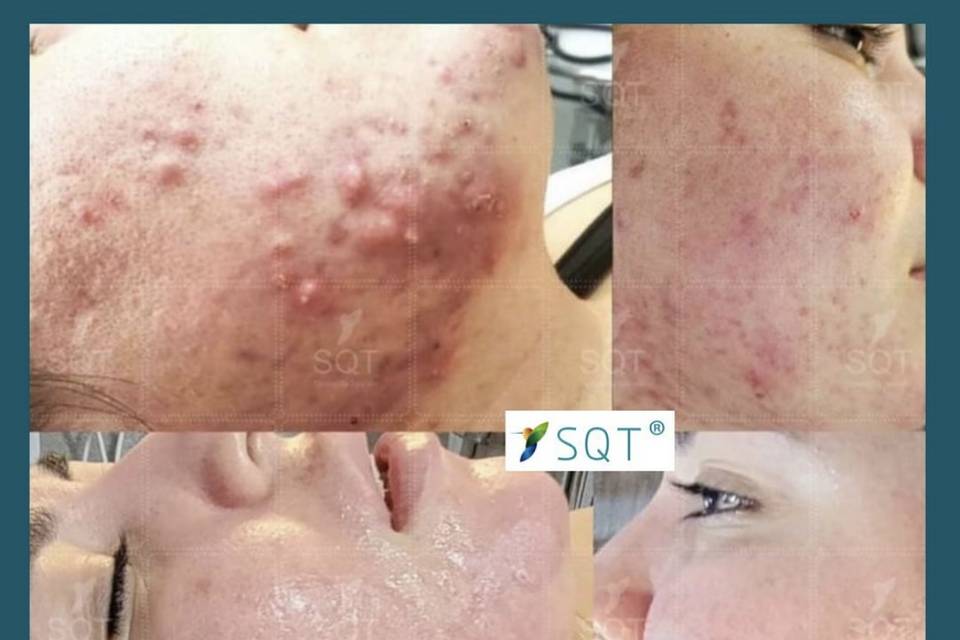 SQT acne protocol