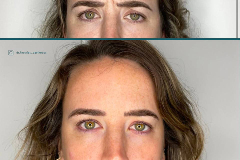 Frown line treatment