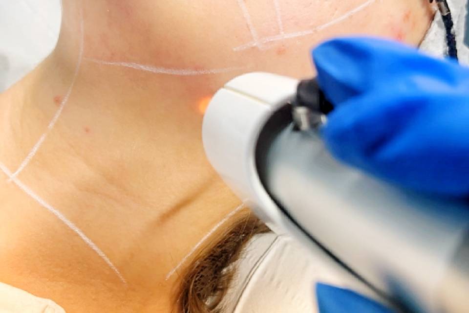 Laser skin Acne