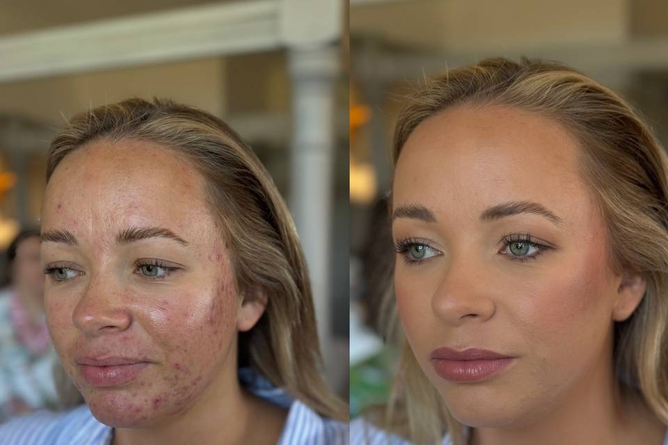 Acne coverage using airbrush