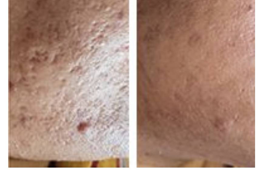 Acne scarring results