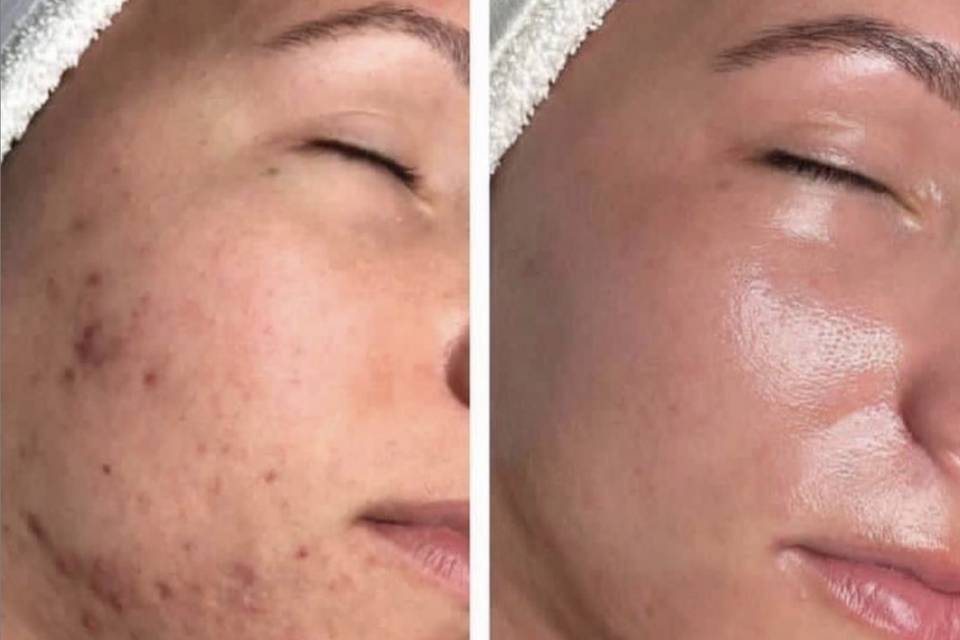 Acne scar removal