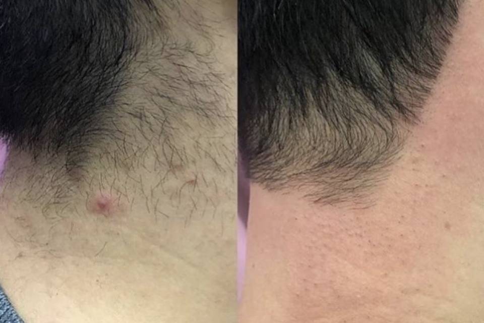 Laser Hair Removal Back Neck