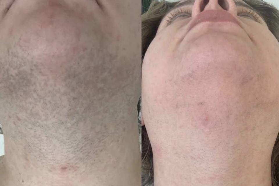 Laser hair removal face