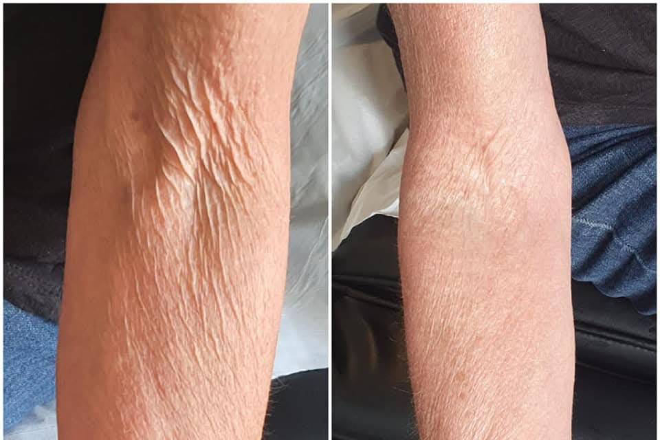 RF Skin tightening