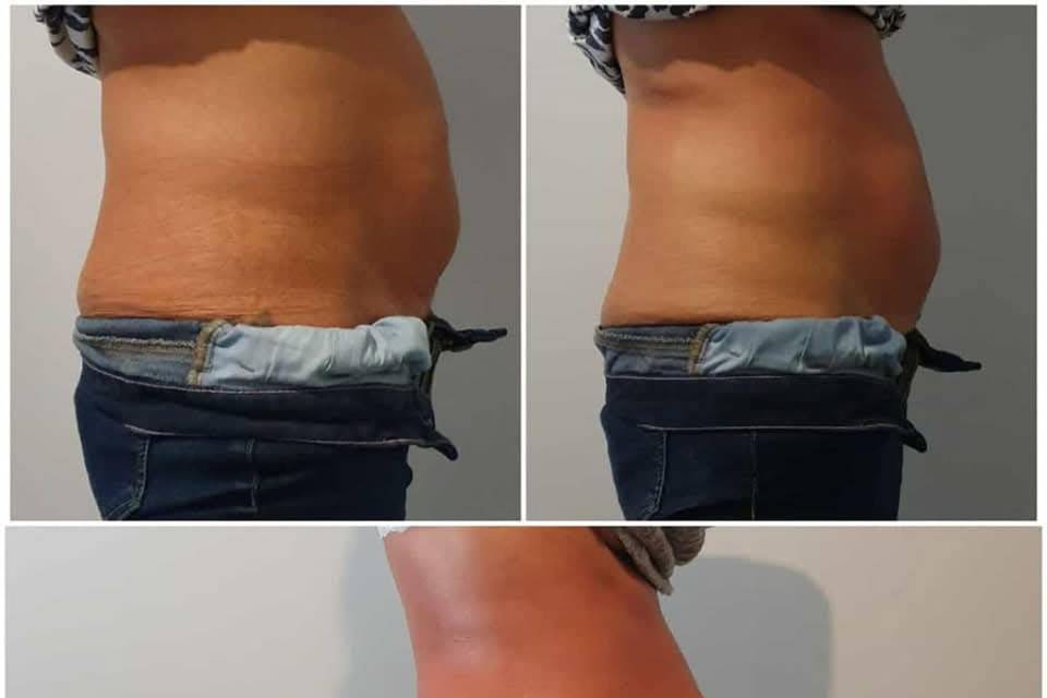 Bodysculpting