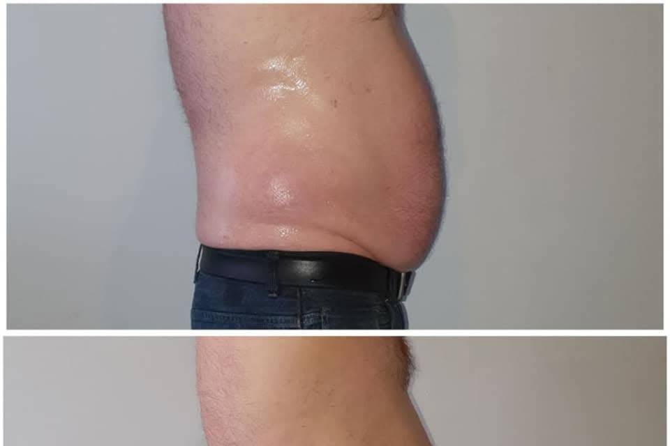 Bodysculpting