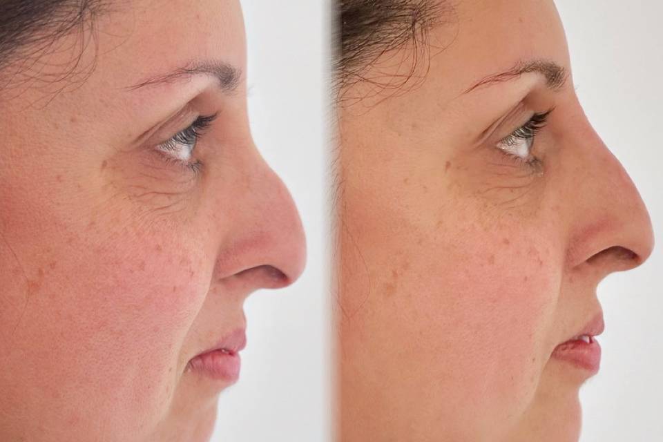 Chin, non-surgical rhinoplasty