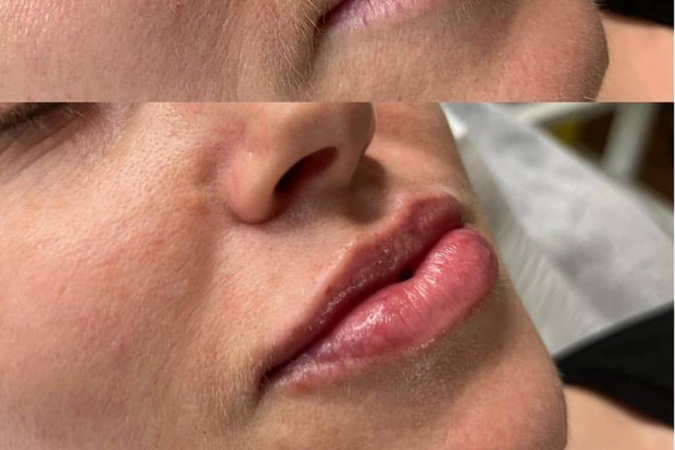 Subtle lip treatments