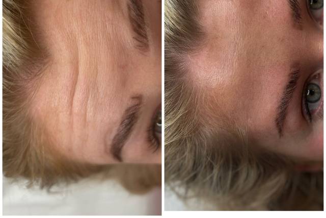 2 Areas of Anti Wrinkle