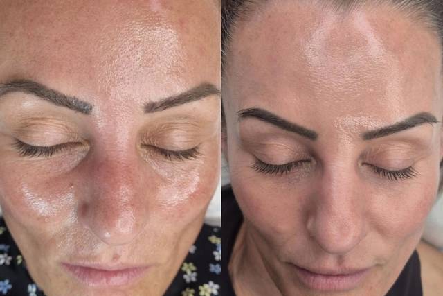 Before & After Skin Journey 4