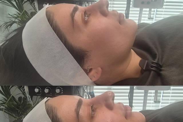 Before & After Skin Journey 3