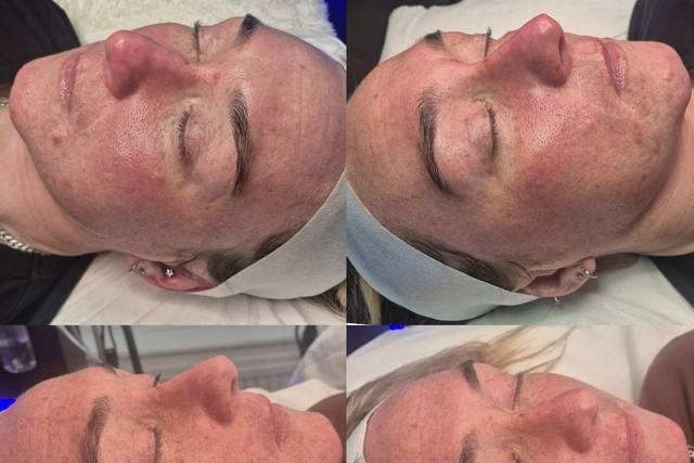 Before & After Skin Journey 2