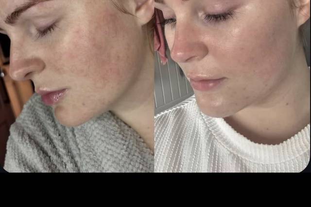 Before & After Skin Journey 1