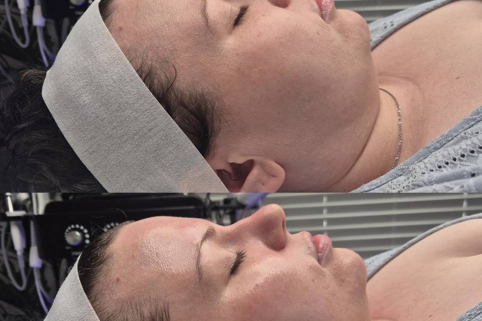Before & After Skin Journey 15