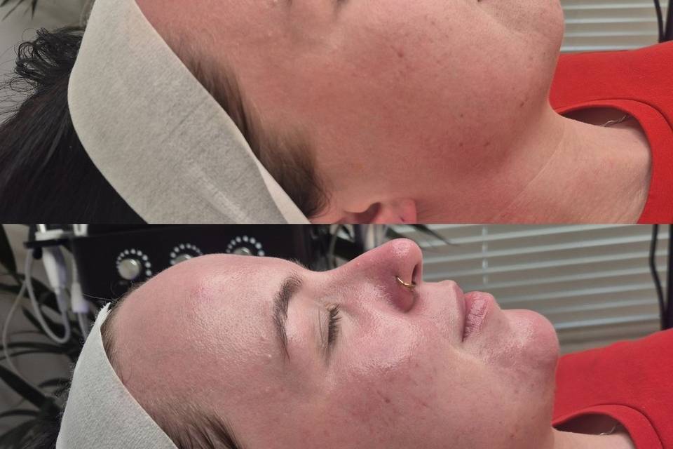 Before & After Skin Journey 17
