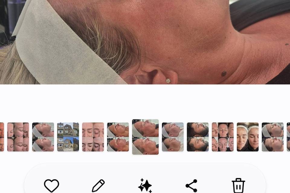 Before & After Skin Journey 14