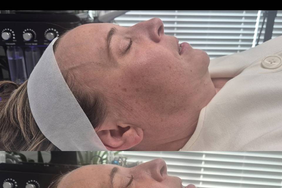 Before & After Skin Journey 18