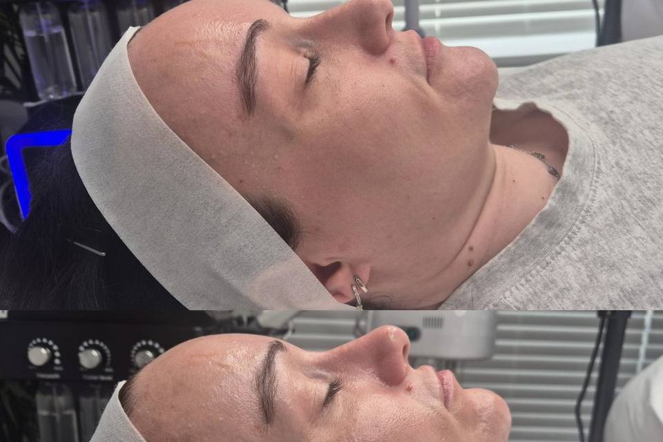 Before & After Skin Journey 8