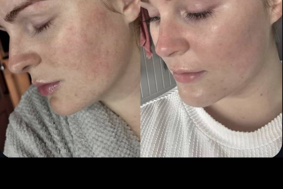 Before & After Skin Journey 1