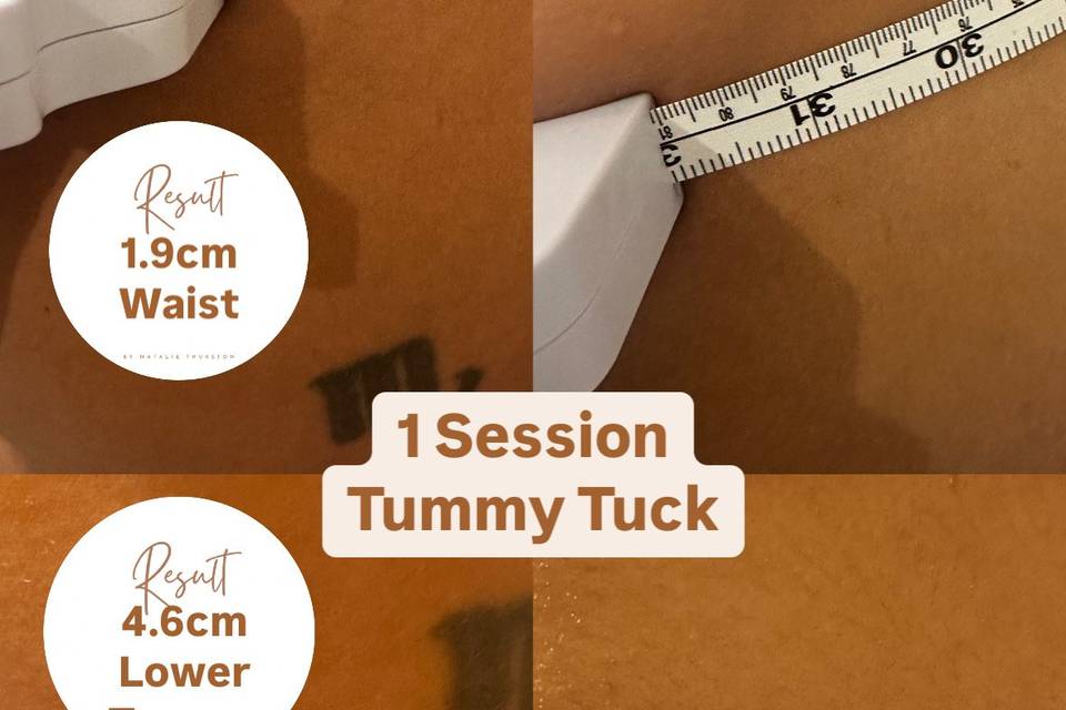 Tummy Tuck measurements