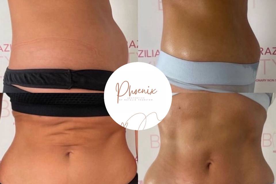 Non Surgical Tummy Tuck