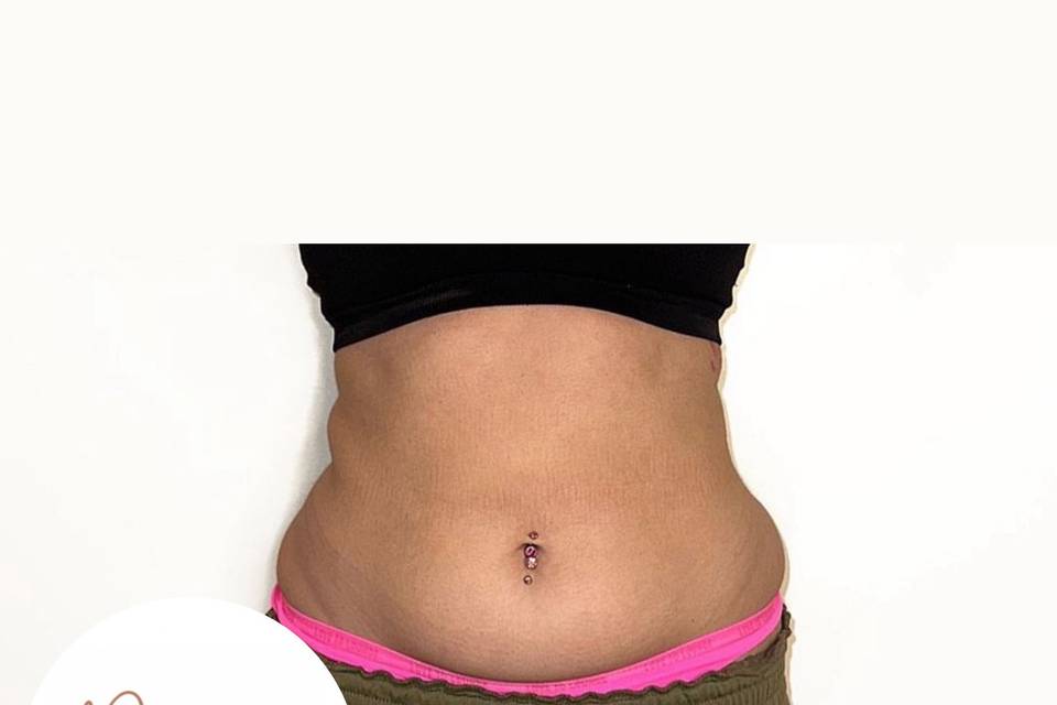 Non Surgical Tummy Tuck