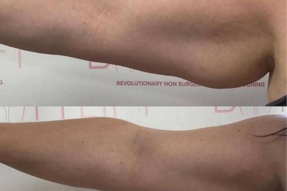 Arm Contouring