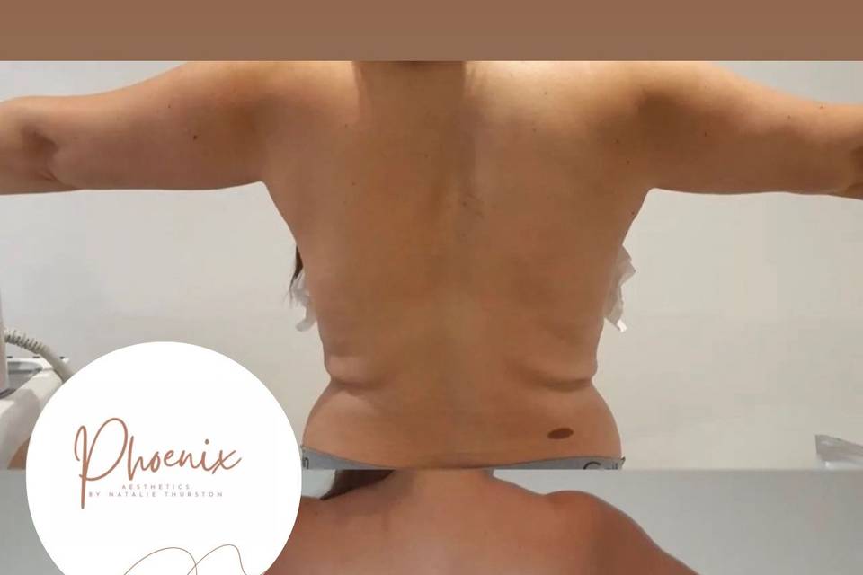 Back sculpting