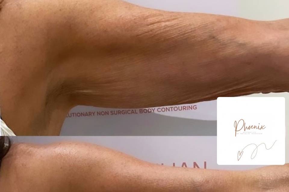 Non surgical arm contouring