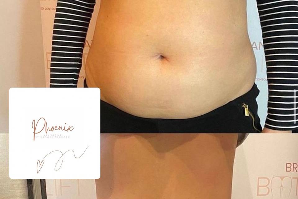 Non Surgical Tummy Tuck