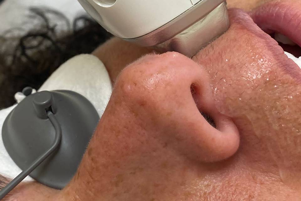 Upper lip treatment