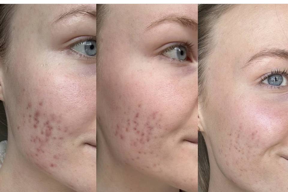 Acne scarring