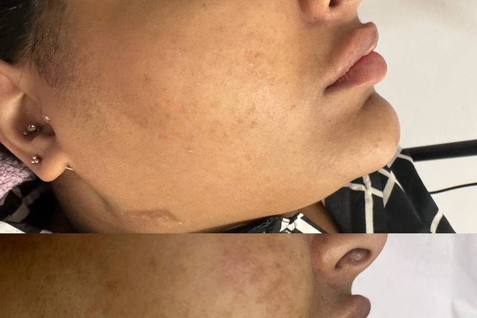 Microneedling