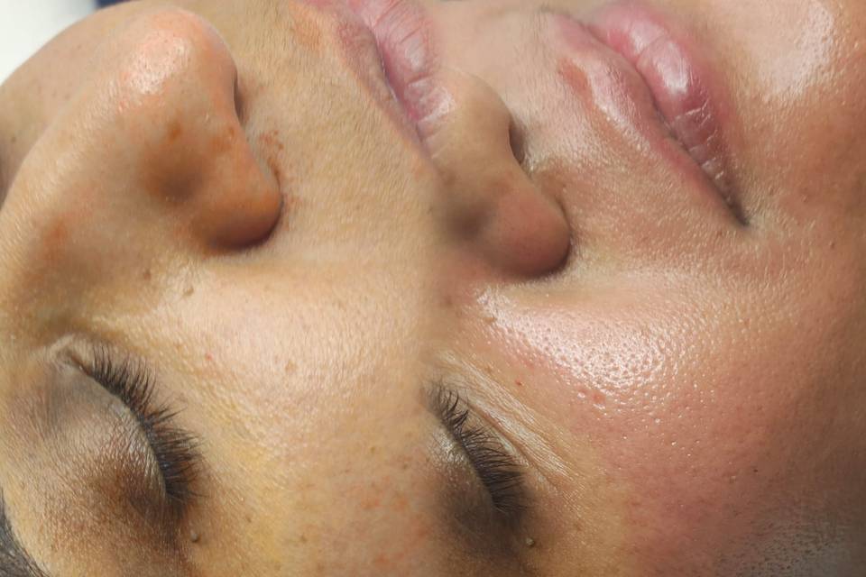 Microneedling