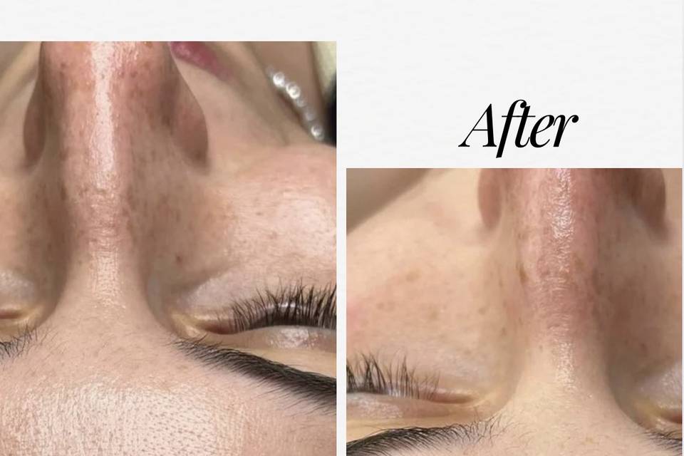 Hydradiamond Facial