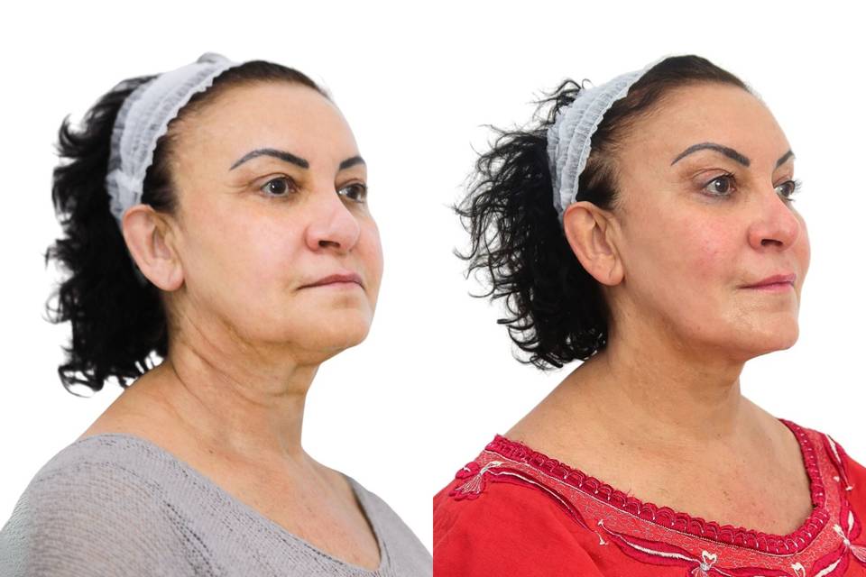 Threadlift by Dr Leah
