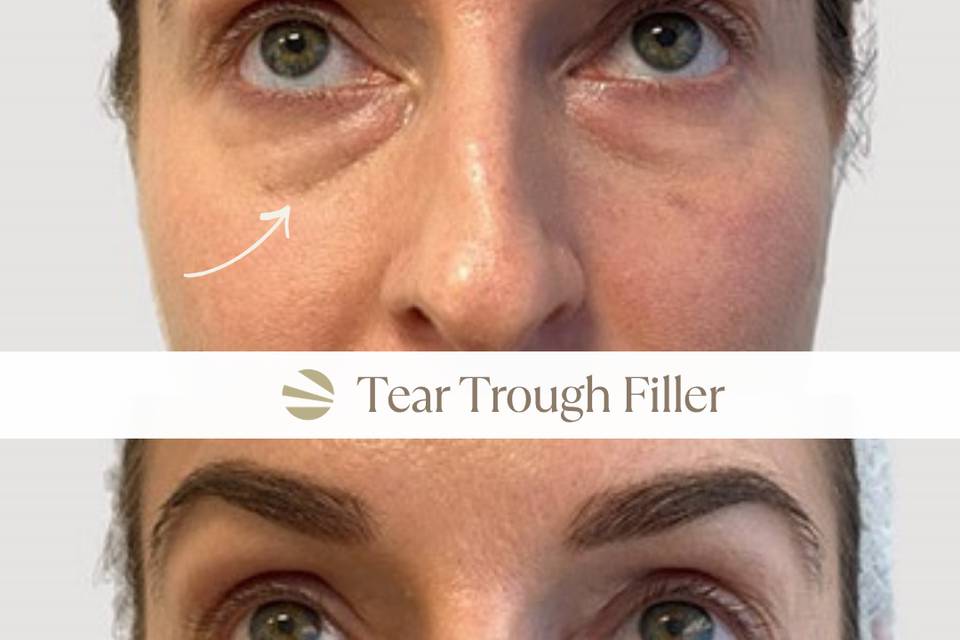 Tear Trough Filler
