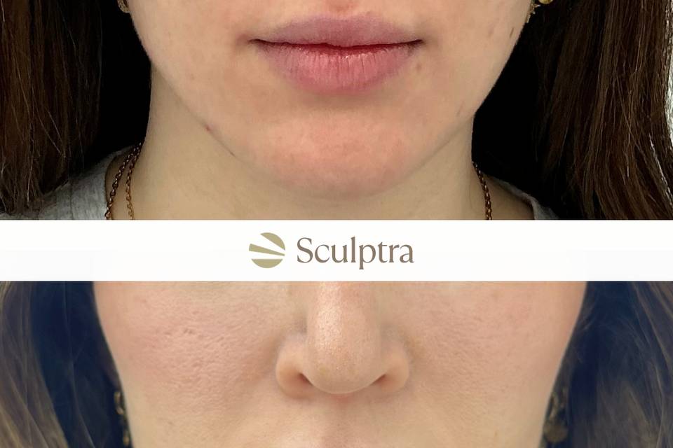 Sculptra