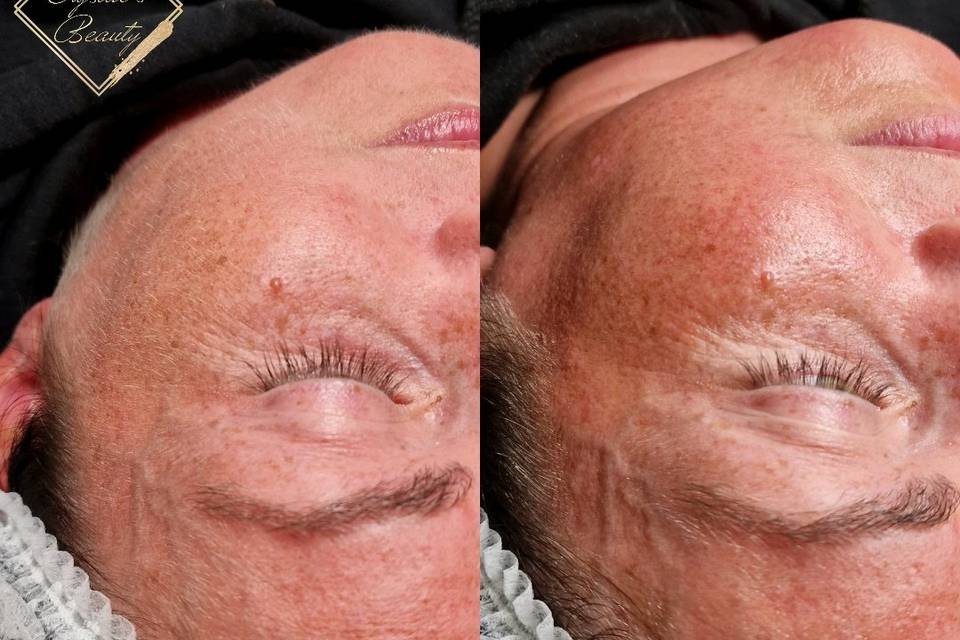 Dermaplaning